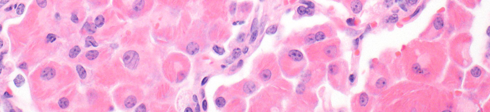 Eosinophilic crystalline pneumonia